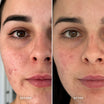 Alpha-H Clear Skin Tonic risultato prima e dopo tre