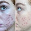 Alpha-H Clear Skin Tonic risultato prima e dopo due