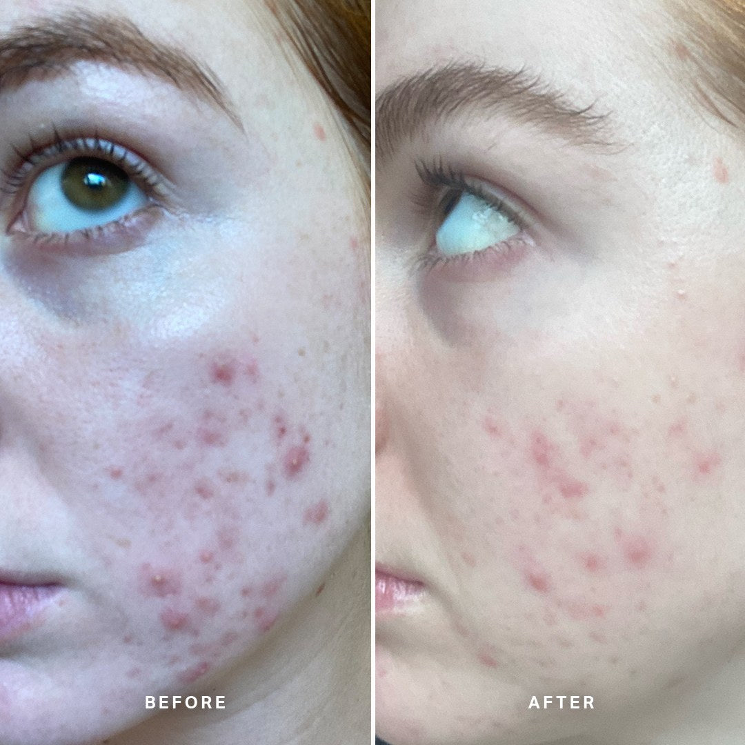 Alpha-H Clear Skin Tonic risultato prima e dopo due