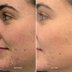 Alpha-H Clear Skin Tonic risultato prima e dopo quattro
