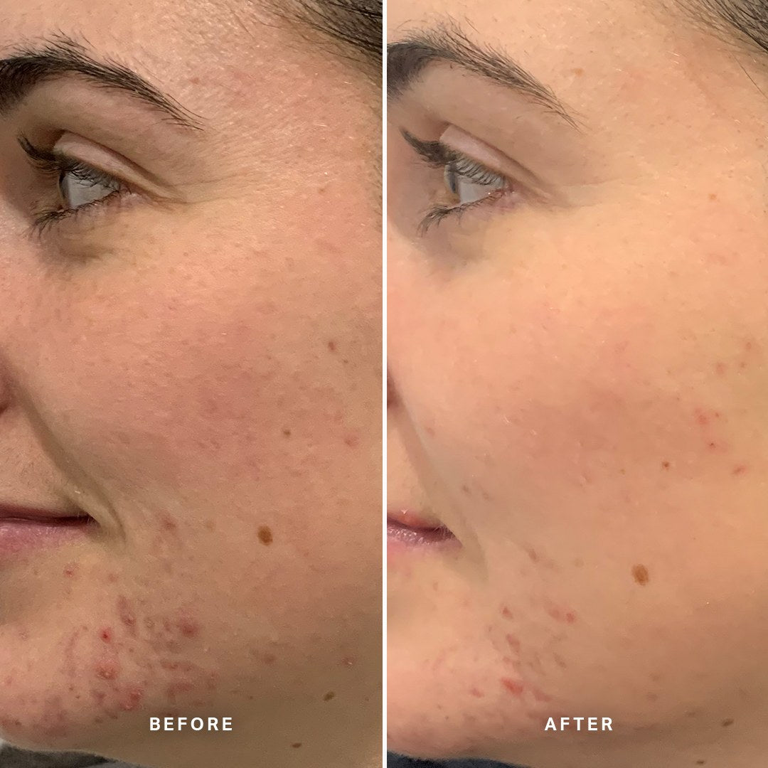 Alpha-H Clear Skin Tonic risultato prima e dopo quattro