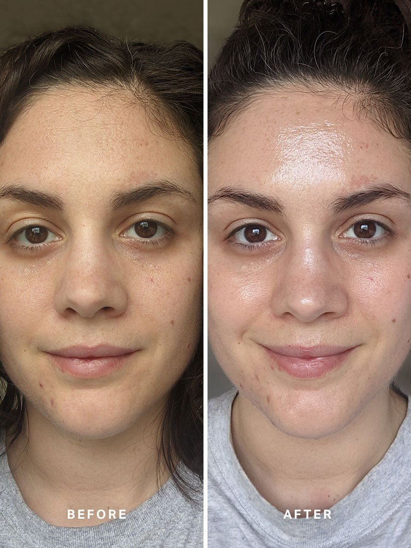 Alpha-H Liquid Gold Exfoliating Treatment prima e dopo risultato due