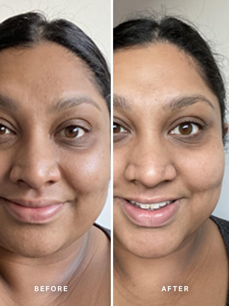 Alpha-H Liquid Gold Exfoliating Treatment prima e dopo risultato quattro