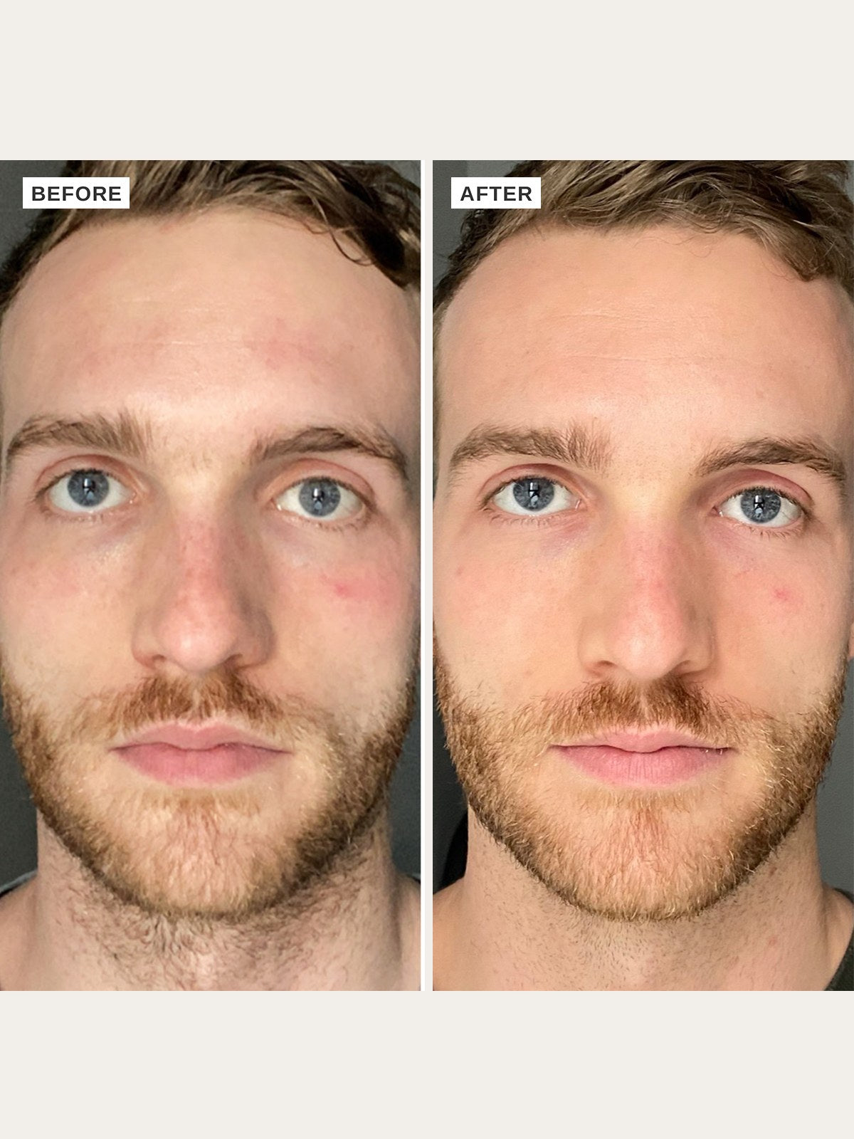 Alpha-H Vitamin B Serum prima e dopo risultato due