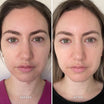 Alpha-H Vitamin B Serum prima e dopo risultato